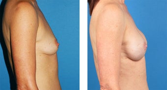 Breast Reconstruction: One-Stage Breast Reconstruction after 561837
