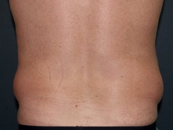 Body Liposculture before 486600