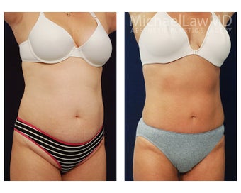 Liposuction after 495015