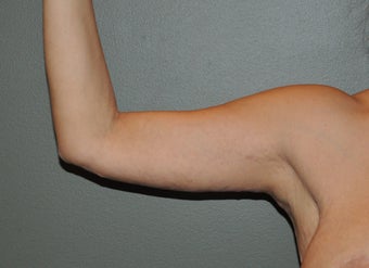 Arm Lift 530723