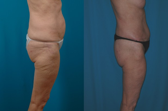 Thigh Lift after 574590