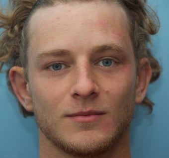 Otoplasty before 271701