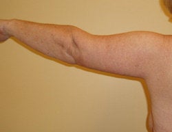 Arm LIft after 330786