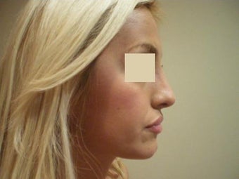 Rhinoplasty after 137956