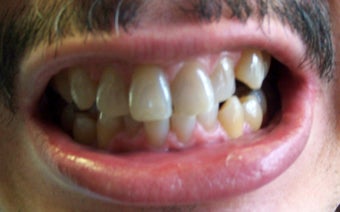 Snap-on Smile before 535255