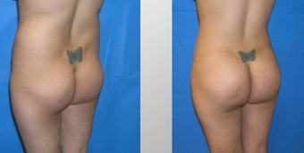 Butt Augmentation before 256438