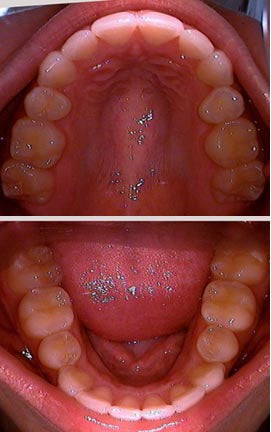 Invisalign after 109376