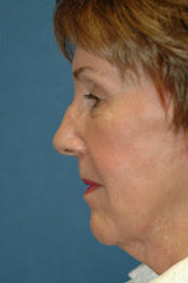 Neck Lift before 324029