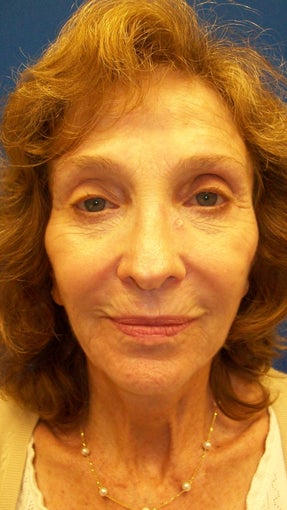 Sculptra before 336917