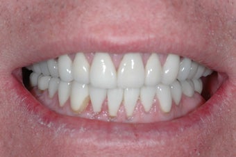 Full Mouth Reconstruction after 358133