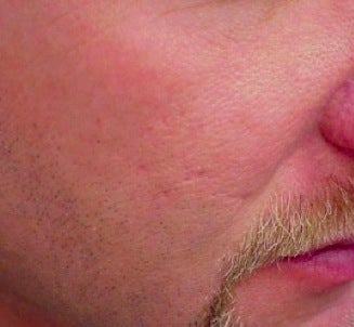 Vbeam treatment for scars after 374583