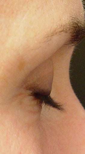 Lashes treated with Lumigan/Latisse before 152211