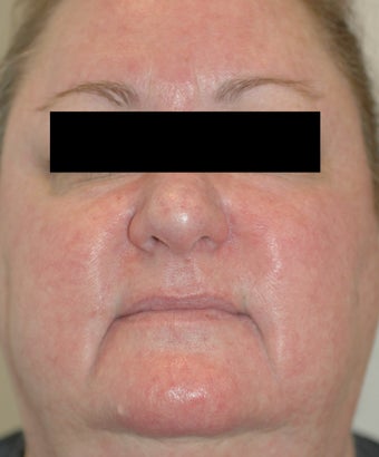 Rosacea Laser Treatment Los Angeles Before and After Pictures after 411345