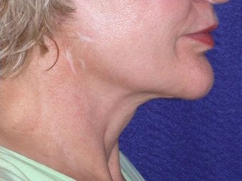 Necklift 208457