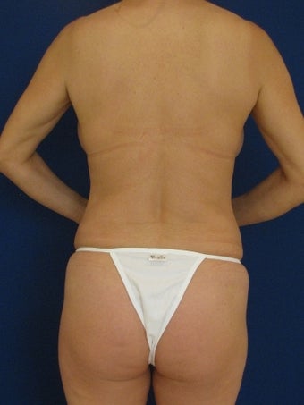 Vaser Hi-Def Liposuction of abdomen, chest, back and flanks before 422714