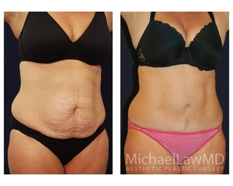 Abdominoplasty - Tummy Tuck after 396176