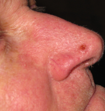 Skin cancer excision with skin graft repair before 313144