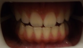 Zoom Teeth Whitening Before and After Photos before 616971