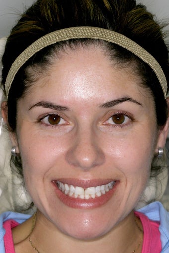Eight porcelain veneers on upper teeth closing midline space. before 391877