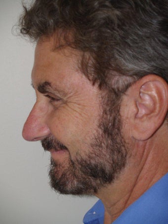 Rhinoplasty after 495965