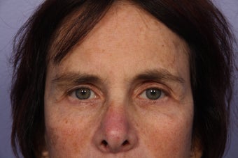 Eyelid Surgery after 306453