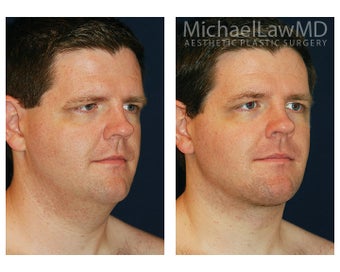 Lower Face and Neck Lift after 395848