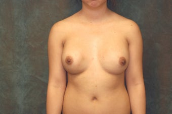 Women's Breast Augmentation: Redo before 553985