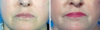 Chemical Peel before 652172