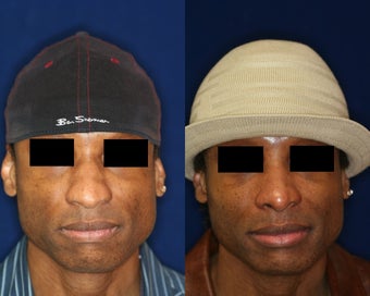 Rhinoplasty and Nostril Narrowing before 223656