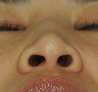 Non Surgical Rhinoplasty 308293