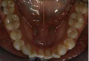 Orthodontic treatment without extraction of teeth before 546583