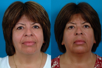 Restylane before 574581