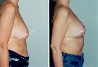 Mastopexy-Breast Lift before 243728