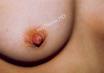 Nipple Surgery after 243246
