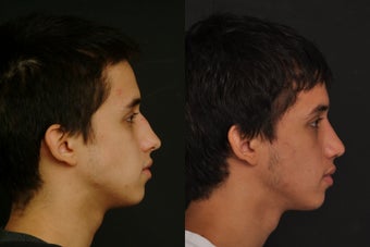 Rhinoplasty 305995