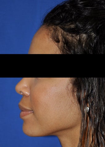 African American Rhinoplasty after 364920