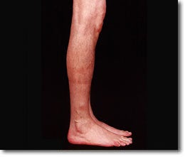 Calf Implant 566013