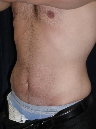 Male Tummy Tuck, Flank Liposuction, Male Breast Reduction 578191