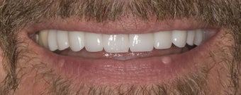 Porcelain Crowns after 374733