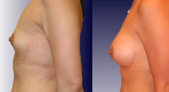 Breast Implants before 192131