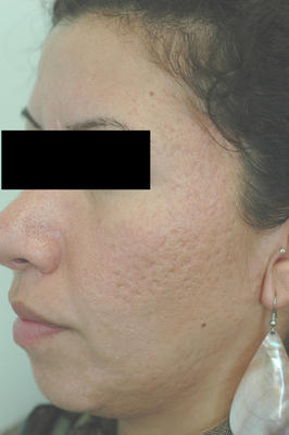 Erbium Laser Resurfacing for Acne Scars before 82973