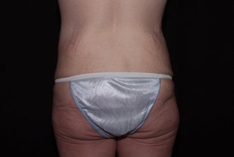Body Lift 479774