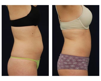 Liposuction 396995