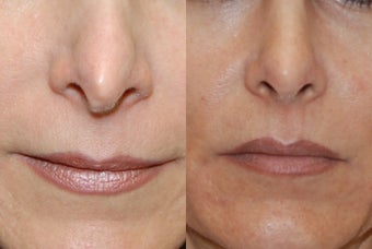 Non-Surgical Rhinoplasty with Silikon-1000 for nostril asymmetry and a pinched tip after previous Rhinoplasty Surgery. before 361231