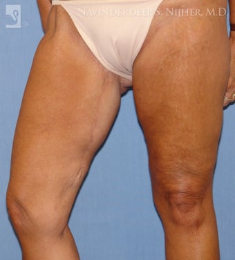 Thigh Lift after 502547