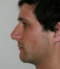 Rhinoplasty revision after 380423
