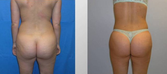 Butt Augmentation before 256431