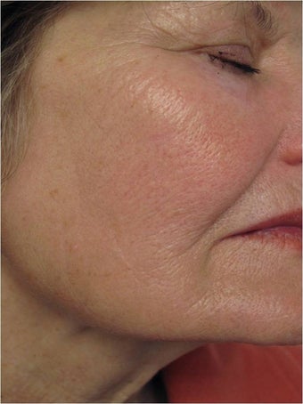 Evolastin- Non Surgical Lift 498659