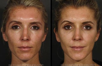 Restylane, Sculptra, Dysport, Obagi Professional C Serum, Cosmelan, Latisse before 320645