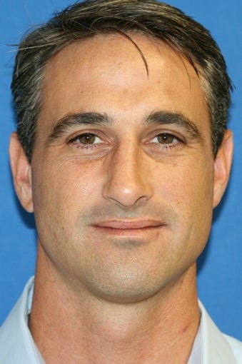 Rhinoplasty after 223229